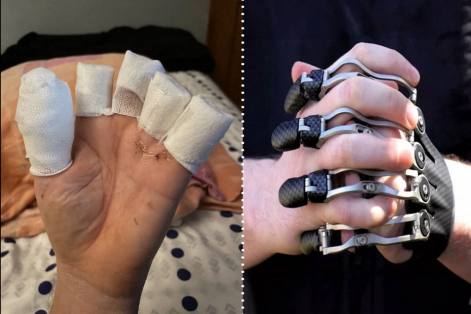 La main de Maxime a été amputée jusqu'à la première phalange. Une prothèse américaine très coûteuse lui permettrait de retrouver sa vie d'avant.